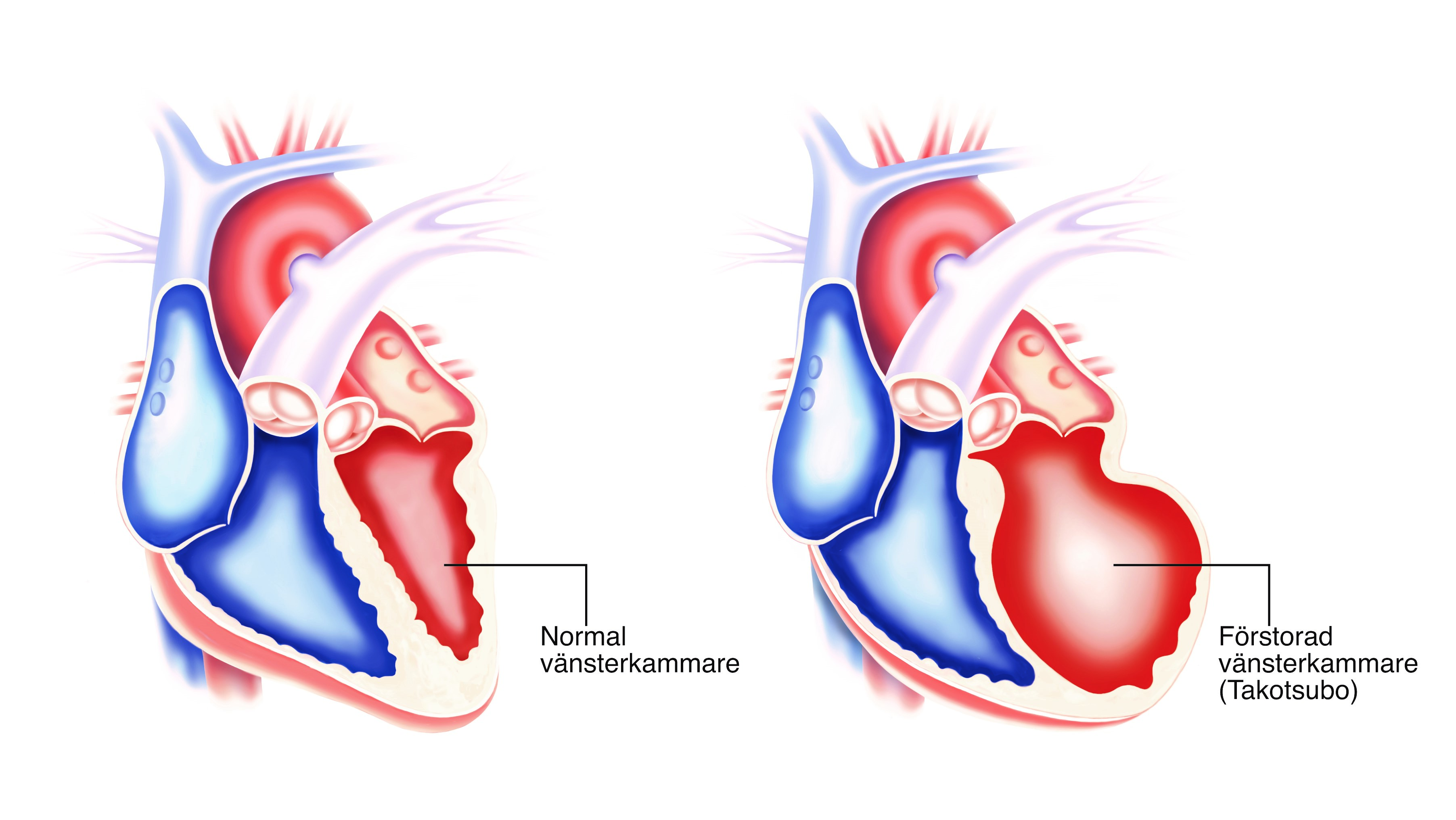 Takotsubo Hjärta i genomskärning